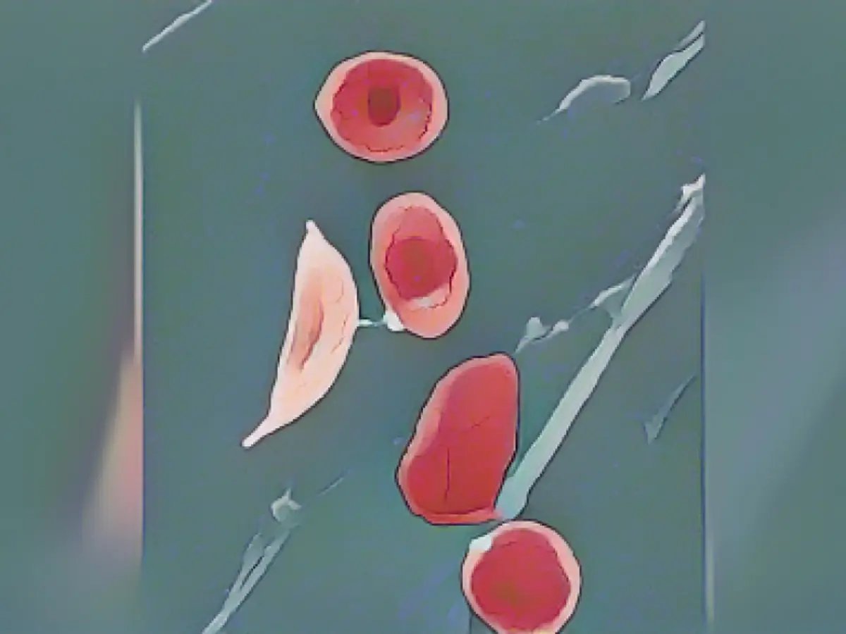 Questa immagine al microscopio mostra una cellula falciforme (a sinistra) e i normali globuli rossi di un paziente affetto da anemia falciforme. Oltre 100 milioni di persone soffrono di questa malattia, la maggior parte delle quali ha origini africane. (Janice Haney Carr/CDC/Sickle Cell Foundation of Georgia via AP)