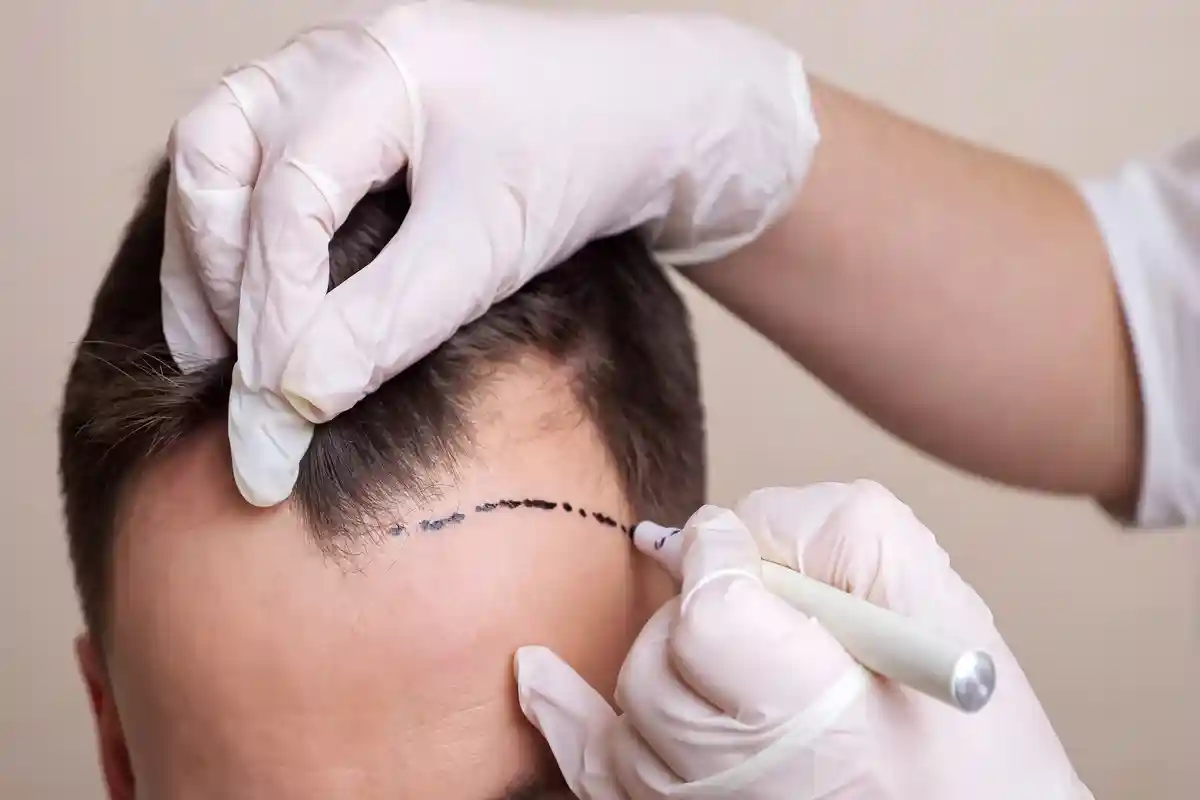 زراعة الشعر بدون حلاقة