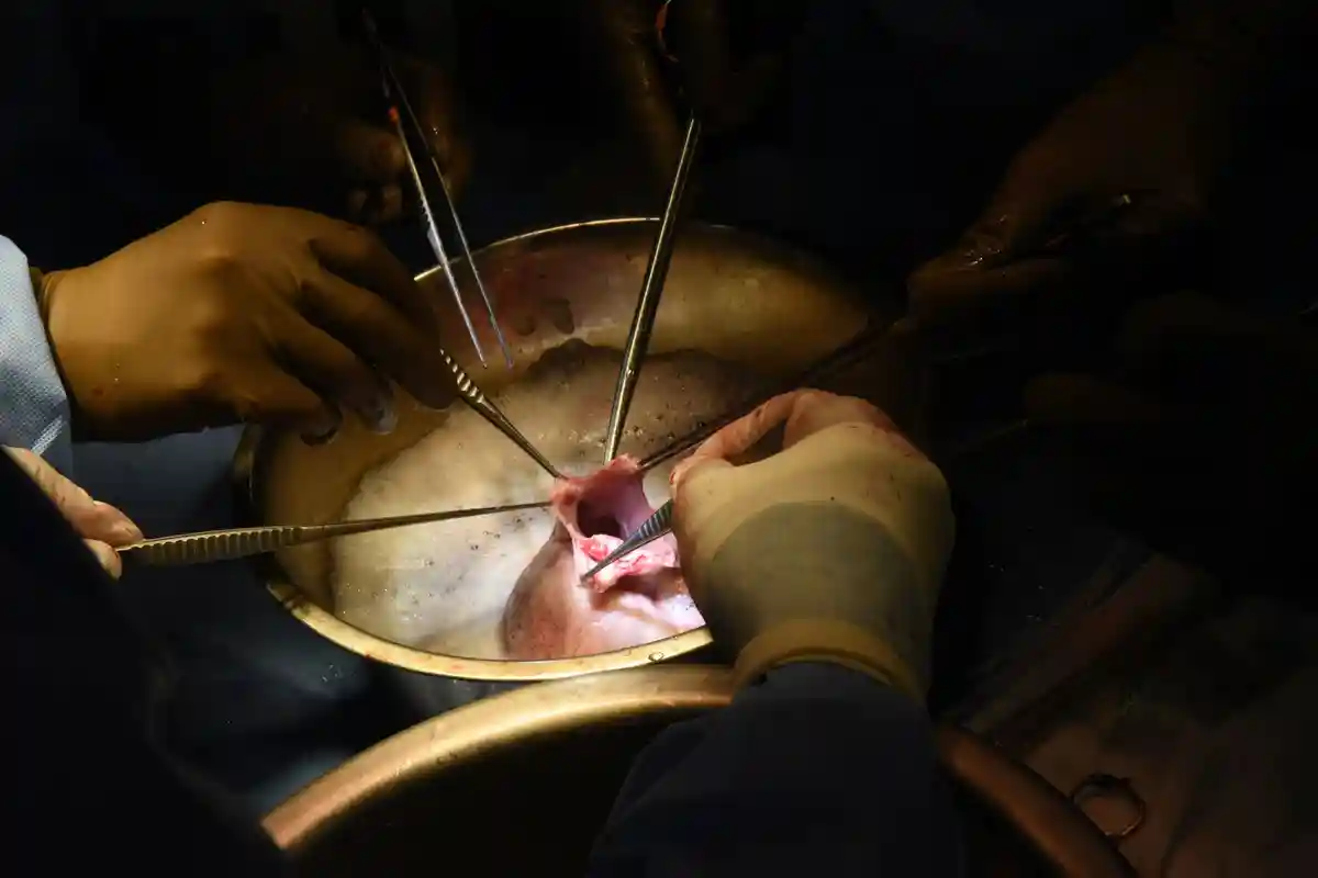 Кардиолог оценил шансы пациента со свиным сердцем